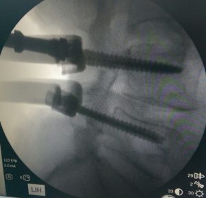 foto de intervención de artrodesis
